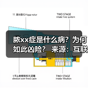 脓xx症是什么病?为何如此凶险? 来源:互联网 2025-08-22(图4) 脓xx症是什么病?为何如此凶险? 来源:互联网 2025-08-22(图4)